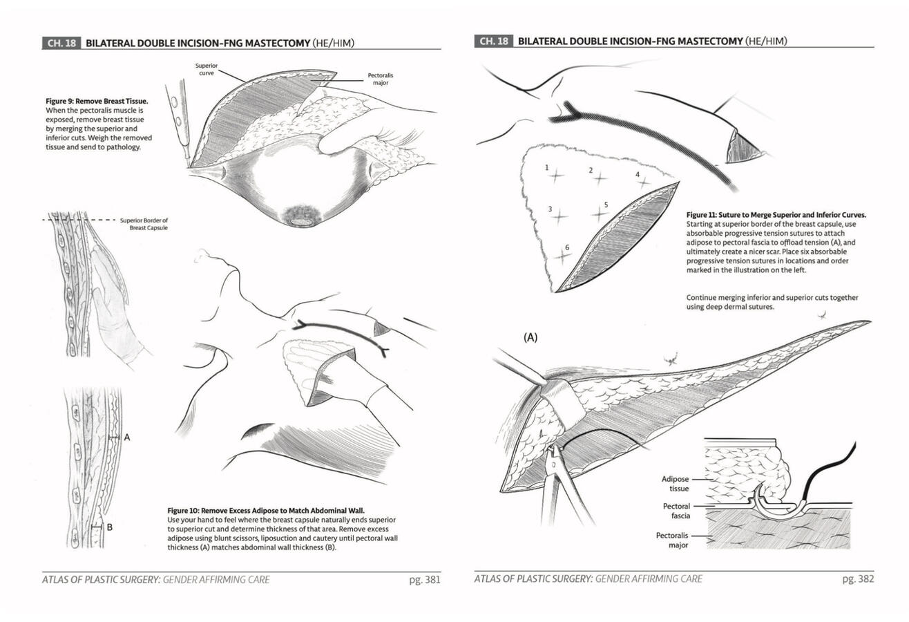 Surgical Manual Mockup Draft: Bilateral Mastectomy with Free Nipple Graft for Chest Masculinization 2D Digital Illustration made using Adobe Illustrator & Photoshop
